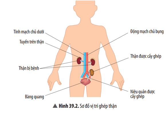 Bạn A cho rằng ghép thận là cắt quả thận bị hỏng và thay vào đúng